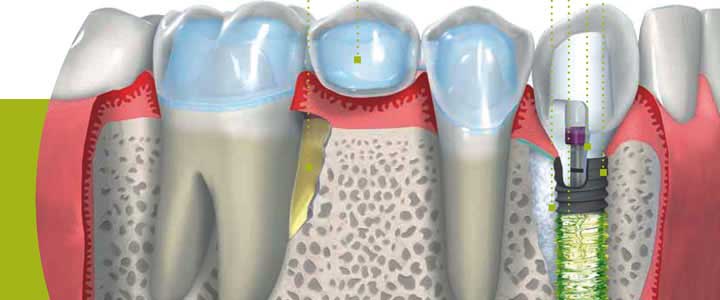 Official Dental Implant Center @ BIDC Official Dental Implant Center @ BIDC