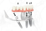 All-On-4™ Immediate Function Implants All-On-4™ Immediate Function Implants