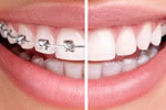 Stb braces Invisible Braces by STb™ Light Lingual Stb braces Invisible Braces by STb™ Light Lingual