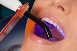 Zoom Tooth Whitening Zoom Tooth Whitening