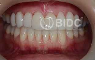 Crowns and Veneers Crowns and Veneers