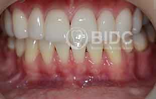 Porcelain Bridges and Crowns Porcelain Bridges and Crowns