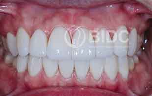 Procelain Veneers Cosmetic Dentistry