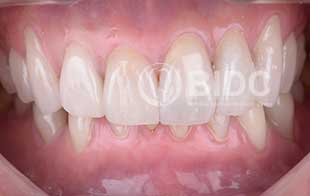 Full Lower Arch Crowns
